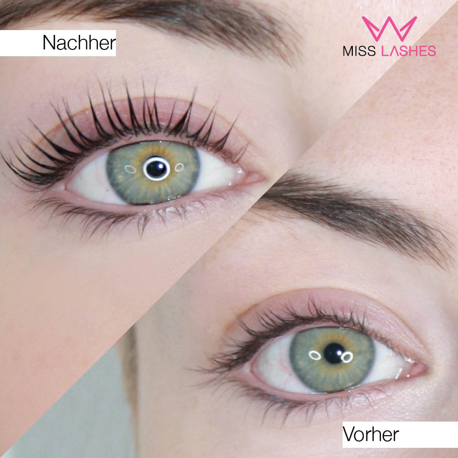 Was tun, wenn das Lass Lifting schief gegangen ist?